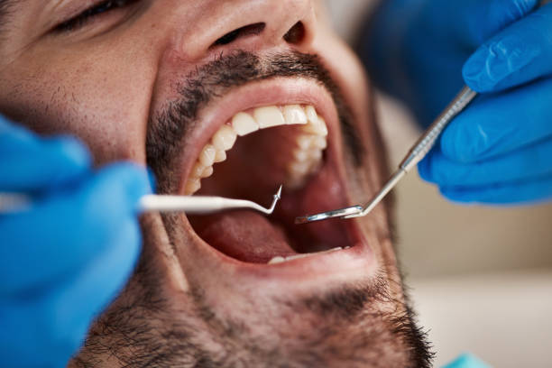 Best Chipped Tooth Repair Near Me  in Taylorvle, IL