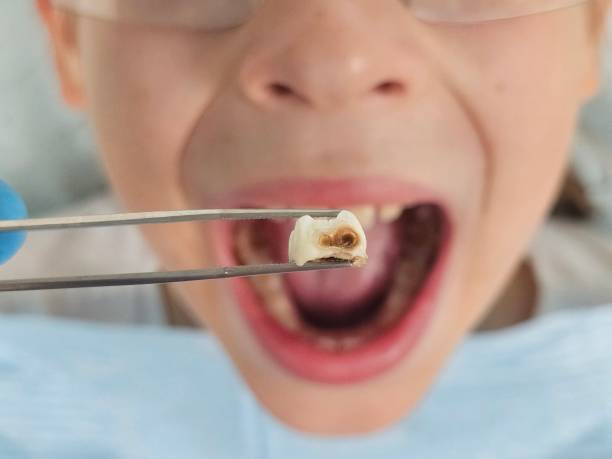 Best Emergency Tooth Extraction  in Taylorvle, IL